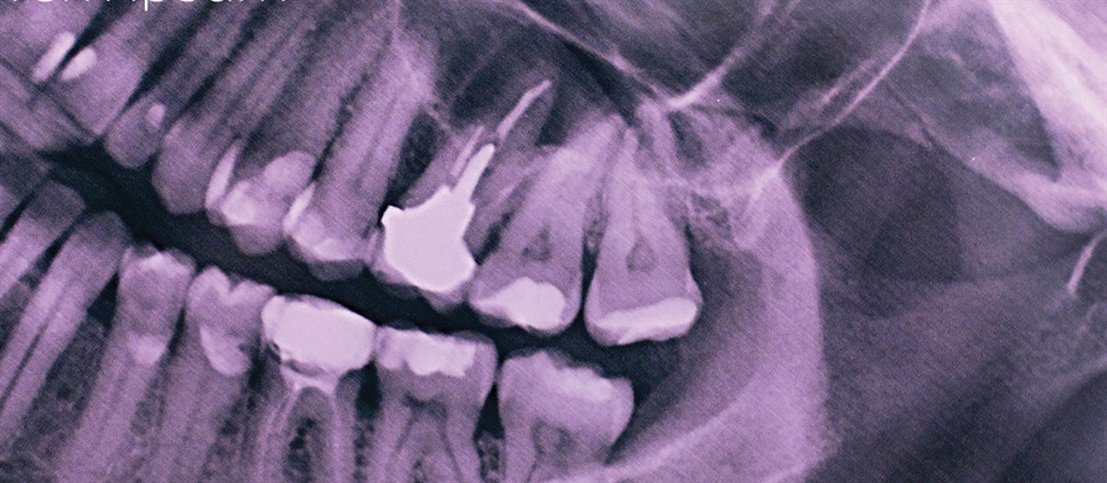 Dental CE: Setting the Tone: Guided Bone Regeneration Techniques